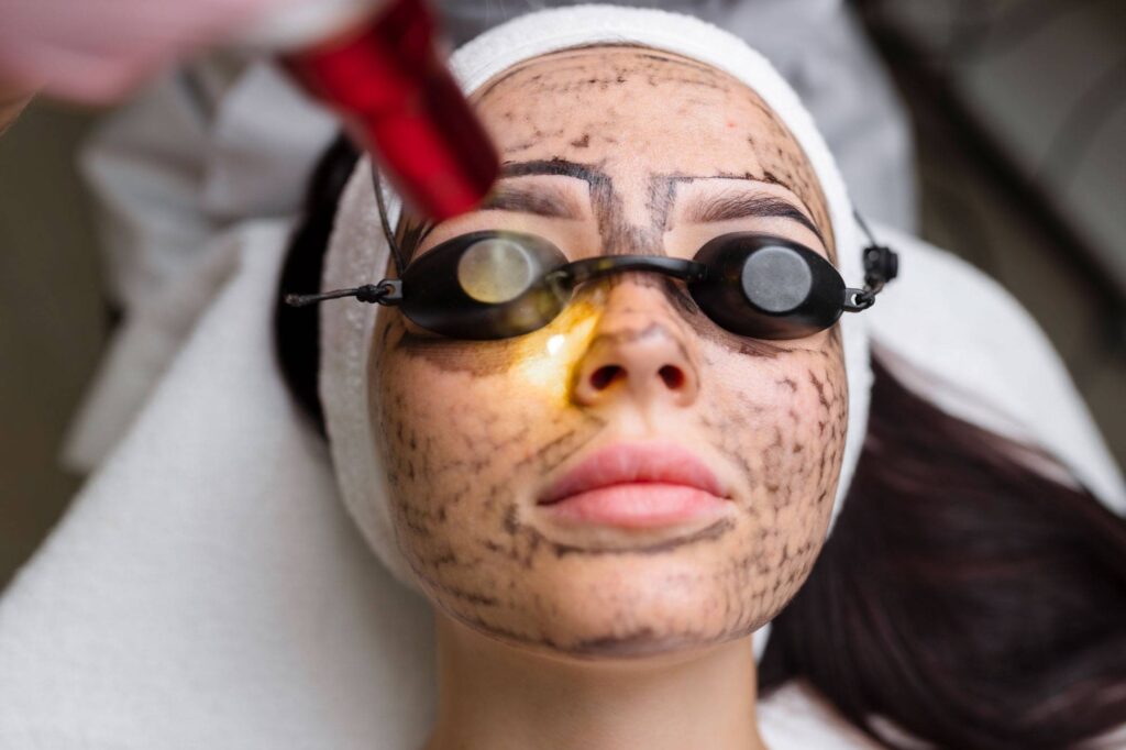 What Areas Can Laser Carbon Peel Treat