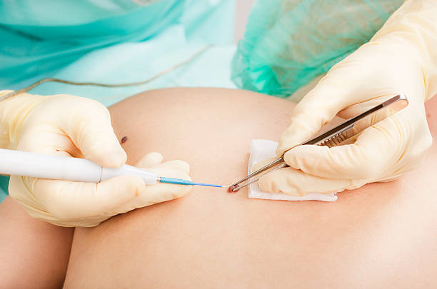 Can Mole Removal Help Improve Clearer Skin Appearance