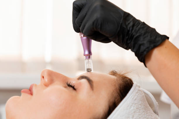 Does RF Microneedling Help Restore Healthy Skin Glow