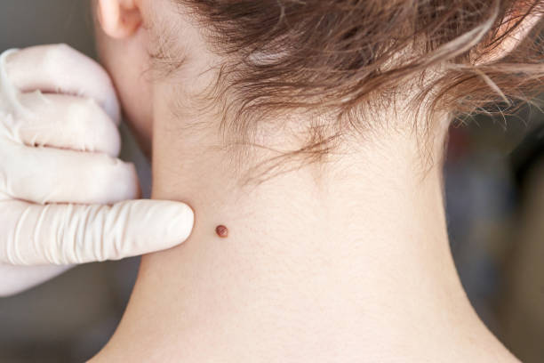 Does Wart Removal Improve Skin Confidence and AppearanceDoes Wart Removal Improve Skin Confidence and Appearance