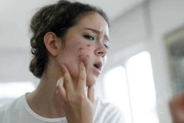 How Does Acne Treatment Improve Confidence In Your Skin