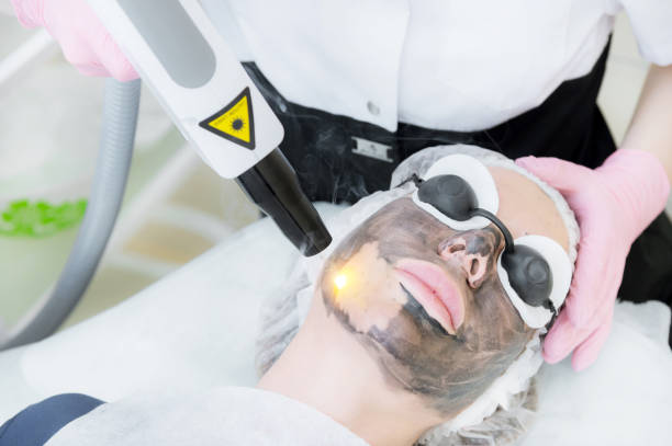 How Quickly Does Laser Carbon Peel Show Visible Skin Results