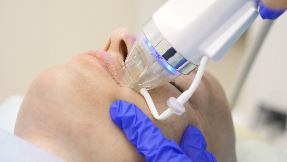 Fractional RF Micro Needling in Abu Dhabi