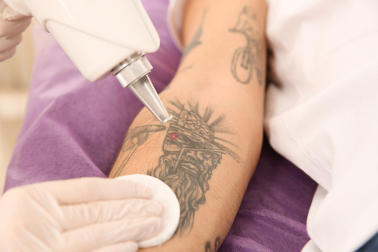 Picosure Tattoo Removal in Abu Dhabi