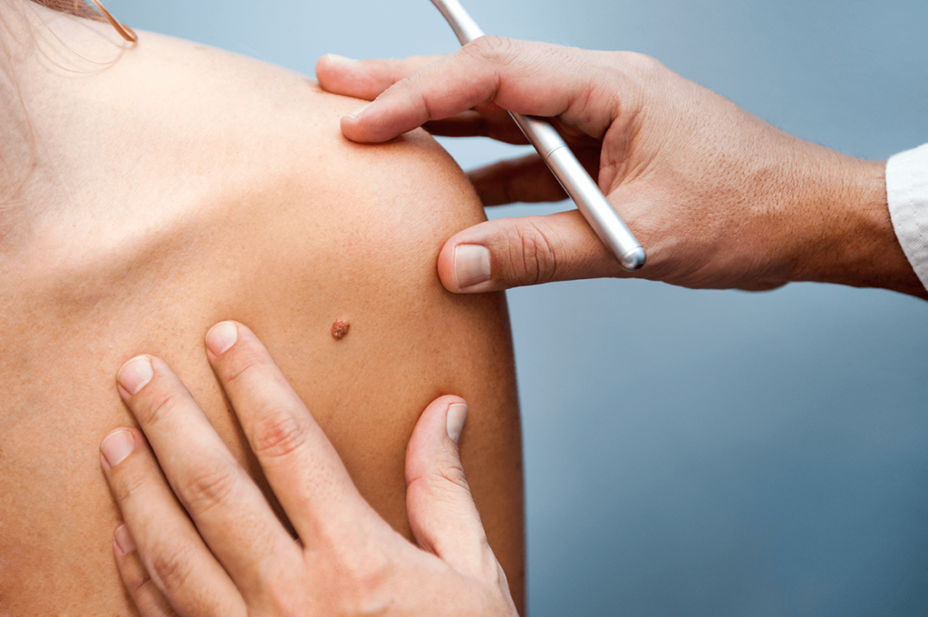 Skin Lesion Removal in Abu Dhabi