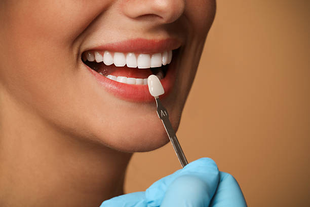 How Dental Veneers in Pakistan Can Completely Transform Your Smile