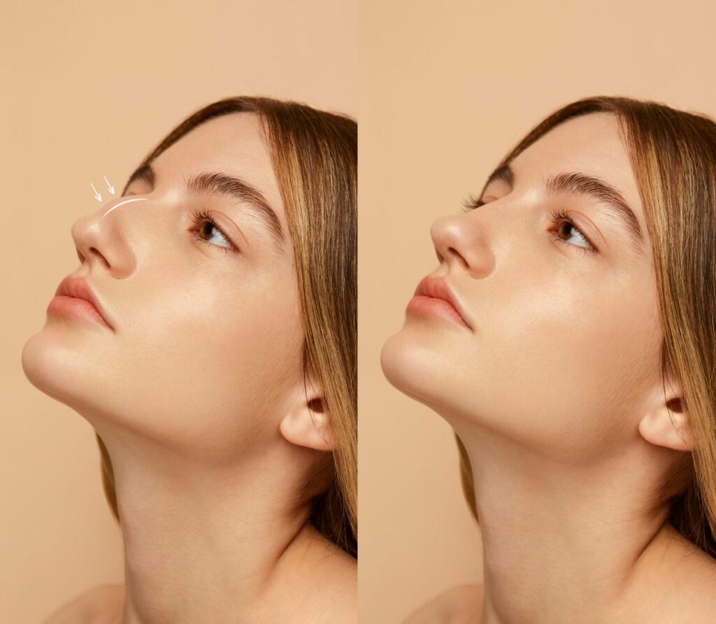 Nose Reshaping in London