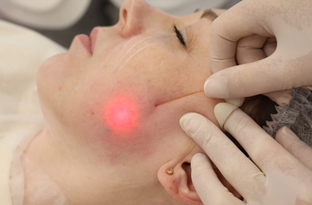 Can Endolift Help Improve the Appearance of Chest Wrinkles