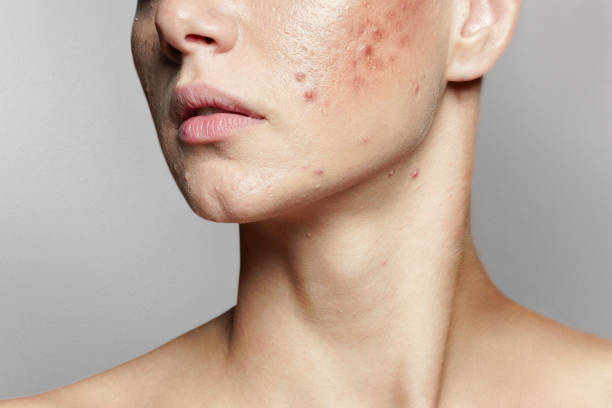 Can Laser Acne Scar Treatment Minimize Visible Skin Damage