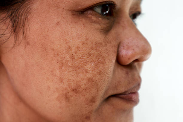 Can Melasma Treatment Help You Feel More Confident Without Makeup