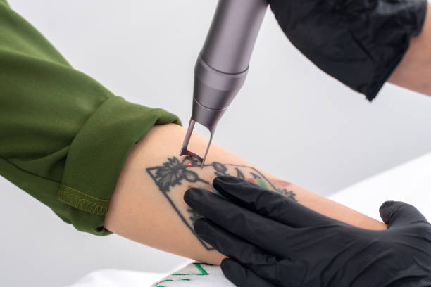 Can Tattoo Removal Reduce the Visibility of Stubborn Ink
