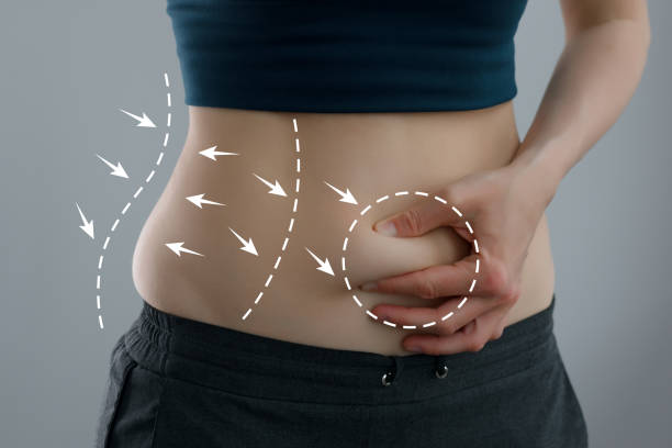 Can a Tummy Tuck Help Create a More Defined Waistline