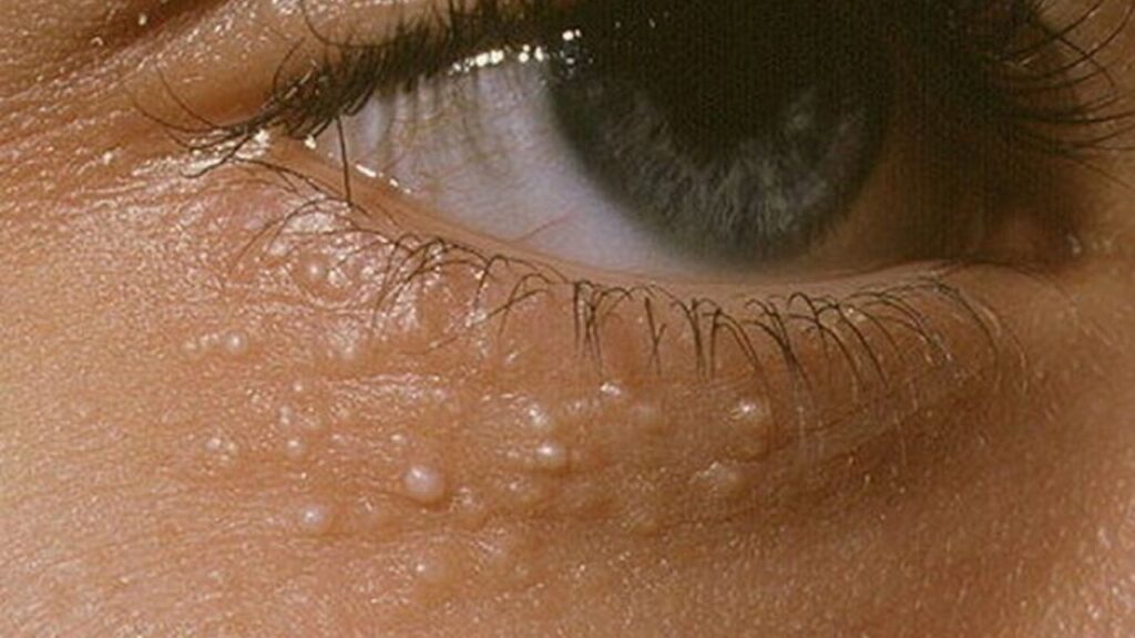 Milia Treatment in Abu Dhabi