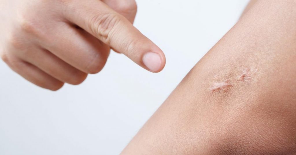 Keloid Treatment Abu Dhabi