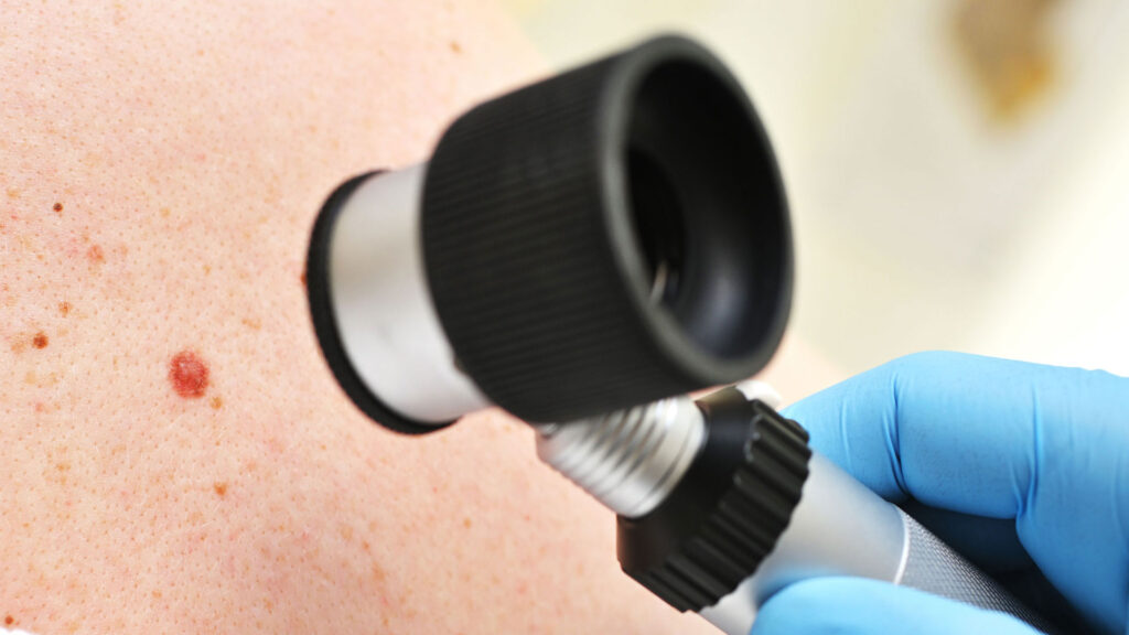 Dermoscopy Mole Evaluation in Abu Dhabi