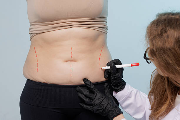 Is Liposuction Worth It for Body Sculpting Goals