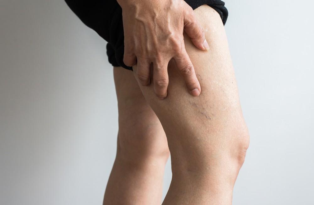 Sclerotherapy Abu Dhabi