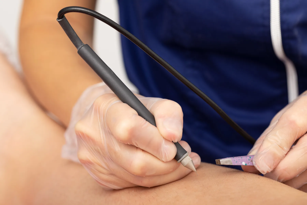 Electrolysis Laser Hair Removal Abu Dhabi