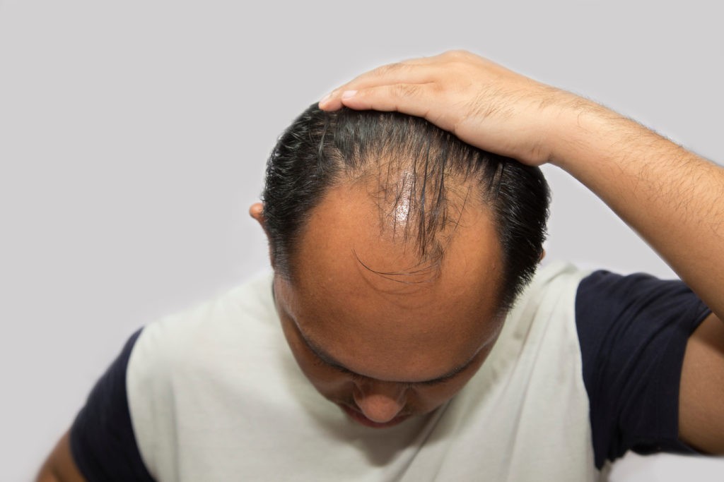 Scalp Micropigmentation Abu Dhabi