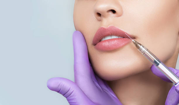 What Results Can You Expect From Lip Fillers Injection
