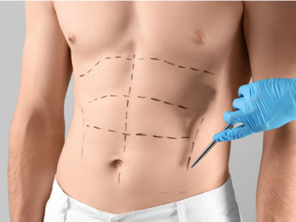 abdominoplasty in Islamabad