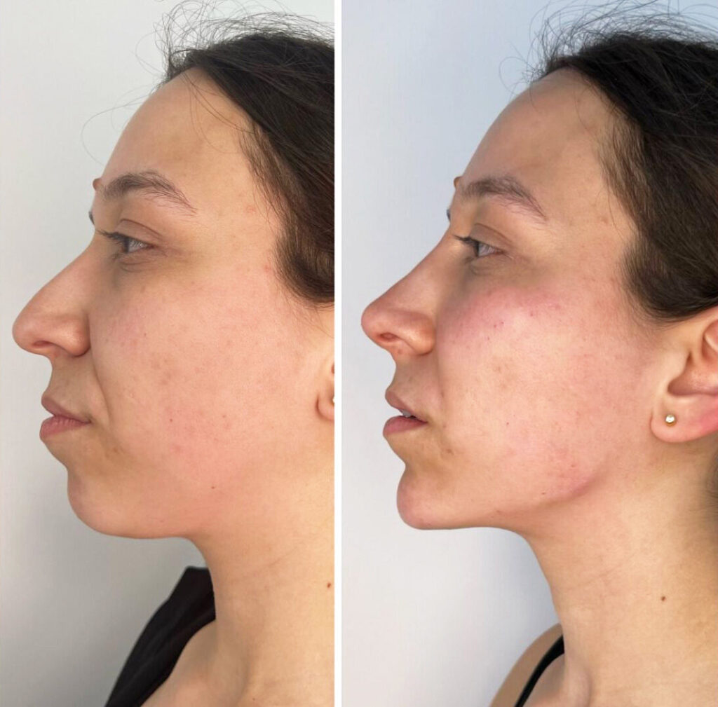 Endolift Laser Dubai