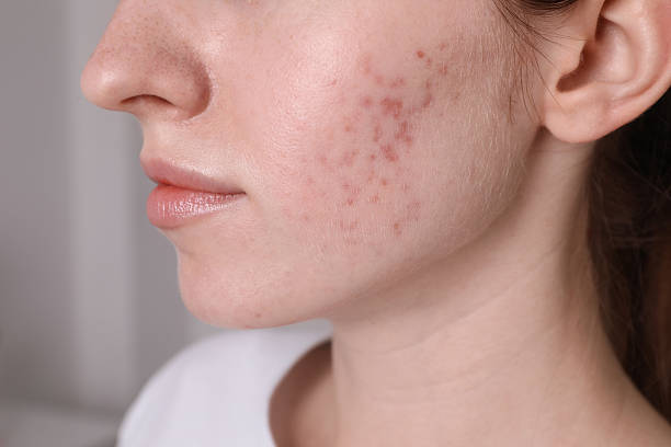 Can Laser Acne Scar Treatment reduce acne marks