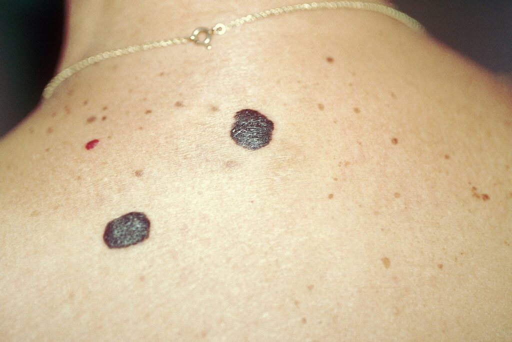Seborrheic Keratosis Treatment in Abu Dhabi