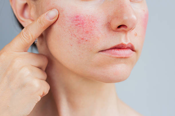 Is Acne Treatment the best option for clear skin
