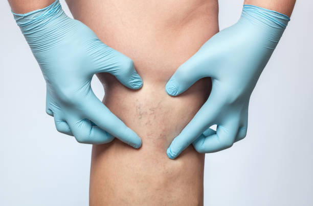 How Effective Is Sclerotherapy for Blue Veins?