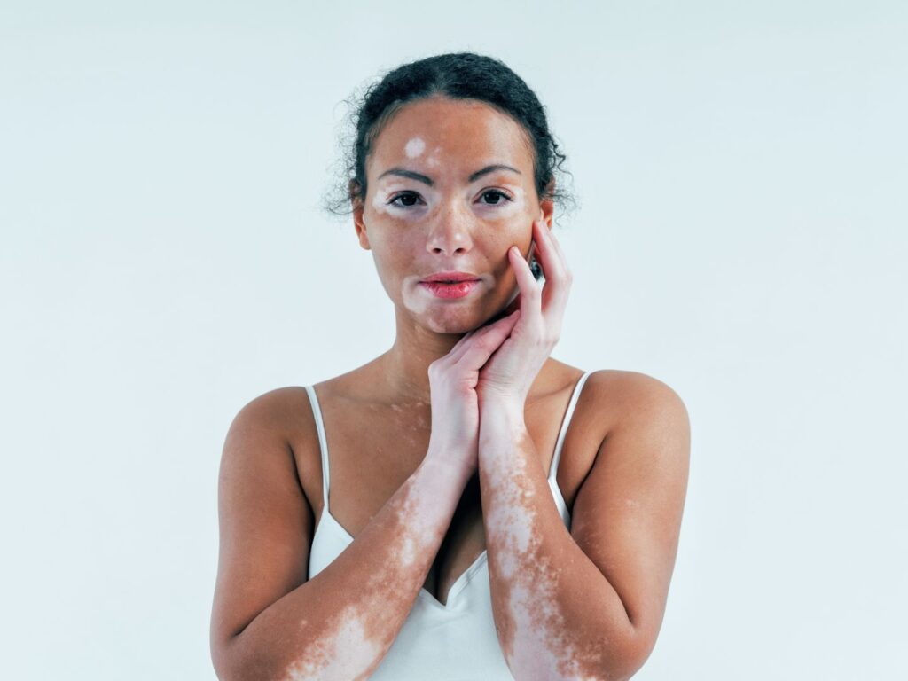 Vitiligo treatment in Abu Dhabi